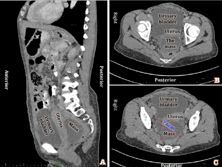CT scan images All these images show a mass located in the posterior pelvis behind the